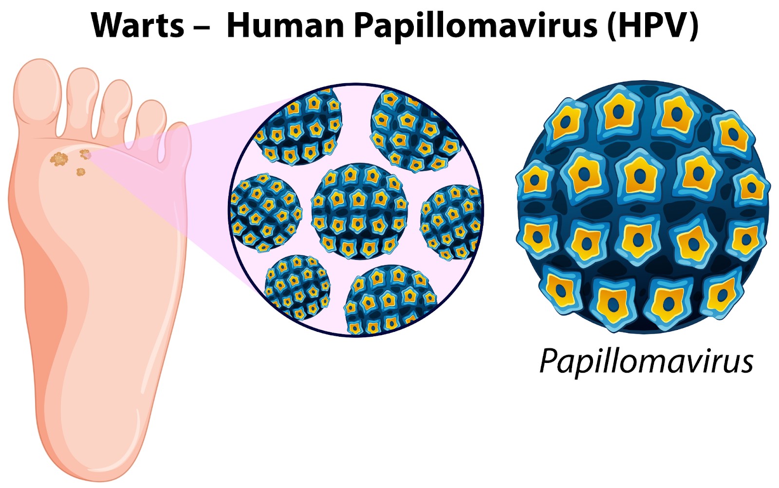 Illustration of plantar warts on the bottom of foot with the germ (HPV virus) causing it 